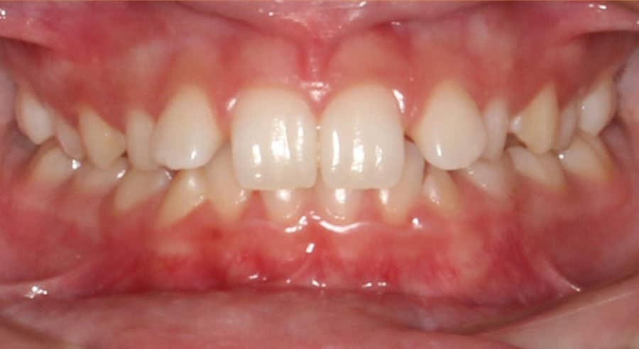 Before And After Invisalign Dillon Orthodontic Care Landstuhl Germany