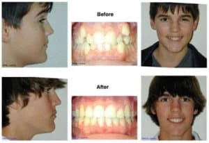 Extraction of Teeth 1