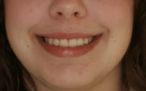 Smile Lift