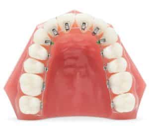 Lingual Braces in Landstuhl, Germany