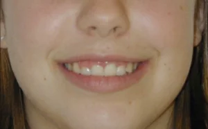 Smile Lift by Braces