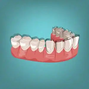 benefits of Invisalign