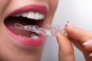 how does Invisalign work