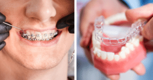 Invisalign vs. braces