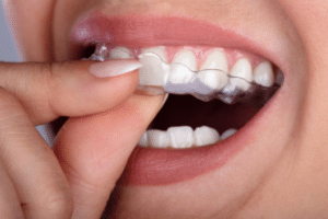at-home-aligners-orthodontist