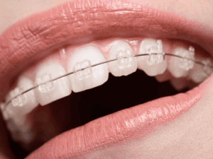 Ceramic Braces