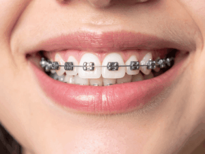 types of braces