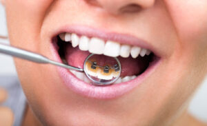 Are Alias lingual braces a good choice