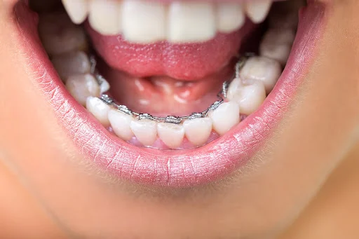 Alias Lingual Braces: A Completely Hidden Orthodontic Solution